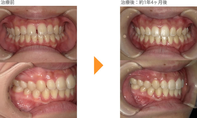 （すきっ歯の症例11）上の前歯のすき間があいている。